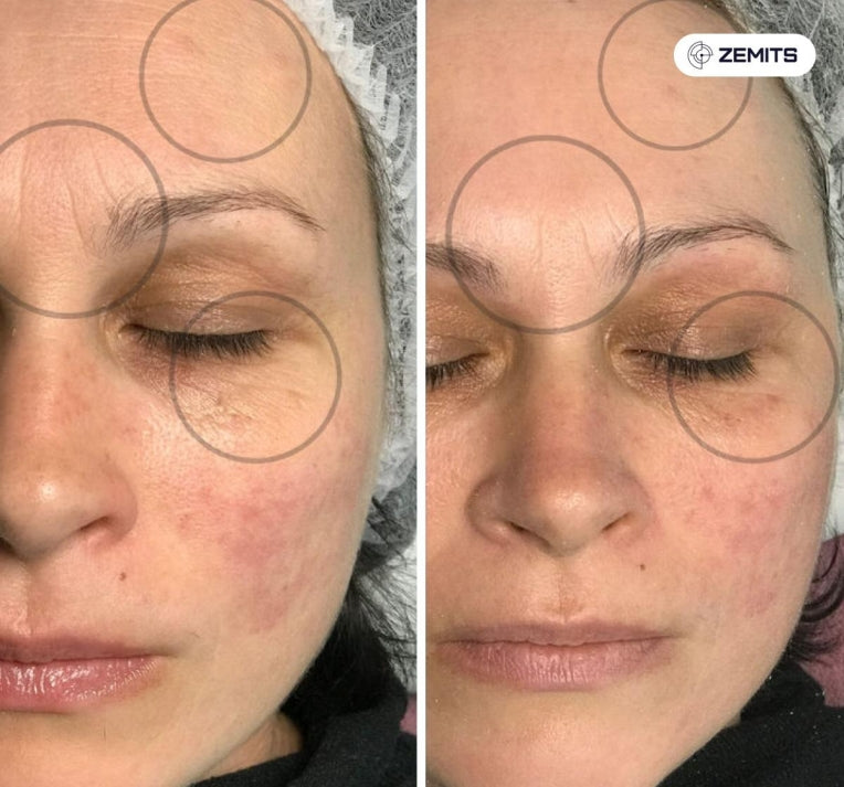 Zemits Klein RF Skin Tightening System