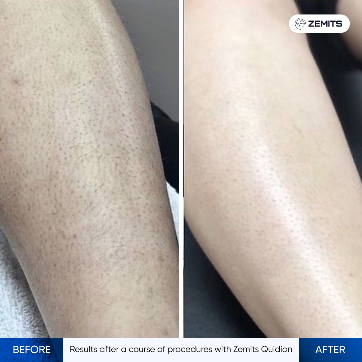 Zemits QuiDion Lite Diode Laser for Hair Removal